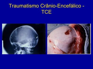 Traumatismo Crânio-Encefálico -
TCE
 