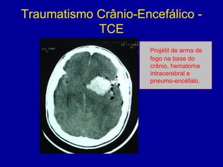 Traumatismo Crânio-Encefálico -
TCE
Projétil de arma de
fogo na base do
crânio, hematoma
intracerebral e
pneumo-encéfalo.
 