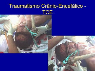 Traumatismo Crânio-Encefálico -
TCE
 