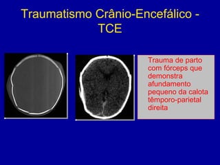 Traumatismo Crânio-Encefálico -
TCE
Trauma de parto
com fórceps que
demonstra
afundamento
pequeno da calota
têmporo-parietal
direita
 