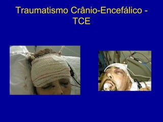 Traumatismo Crânio-Encefálico -
TCE
 