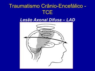 Traumatismo Crânio-Encefálico -
TCE
Lesão Axonal Difusa – LAD
 