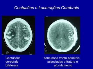 Contusões contusões fronto-parietais
cerebrais associadas a fratura e
bilaterais afundamento
Contusões e Lacerações Cerebrais
 