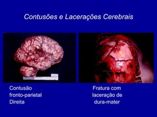 Contusão Fratura com
fronto-parietal laceração de
Direita dura-mater
Contusões e Lacerações Cerebrais
 