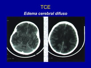 TCE
Edema cerebral difuso
 