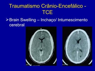Traumatismo Crânio-Encefálico -
TCE
Brain Swelling – Inchaço/ Intumescimento
cerebral
 