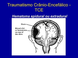 Traumatismo Crânio-Encefálico -
TCE
Hematoma epidural ou extradural
 