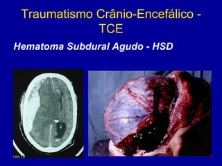 Traumatismo Crânio-Encefálico -
TCE
Hematoma Subdural Agudo - HSD
 