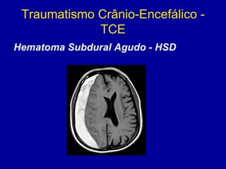 Traumatismo Crânio-Encefálico -
TCE
Hematoma Subdural Agudo - HSD
 