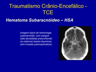 Traumatismo Crânio-Encefálico -
TCE
Hematoma Subaracnóideo – HSA
Imagem típica de hemorragia
subaracnoide, com sangue
(alta densidade) preenchendo
as cisternas basais liquoricas,
sem invasão parenquimatosa.
 