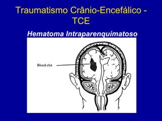 Traumatismo Crânio-Encefálico -
TCE
Hematoma Intraparenquimatoso
 