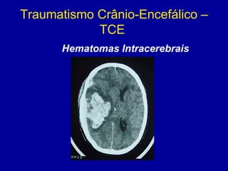 Traumatismo Crânio-Encefálico –
TCE
Hematomas Intracerebrais
 