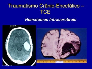 Traumatismo Crânio-Encefálico –
TCE
Hematomas Intracerebrais
 