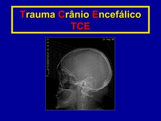 TTraumarauma CCrâniorânio EEncefáliconcefálico
TCETCE
 