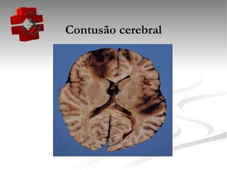 Contusão cerebral 