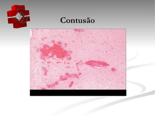 Contusão 