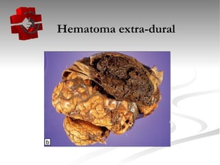   Hematoma extra-dural 