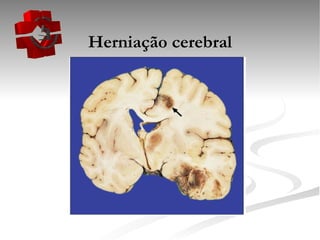 Herniação cerebral 