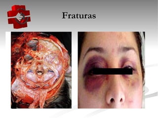 Fraturas 