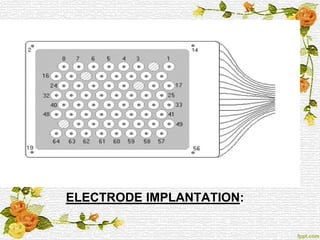 ELECTRODE IMPLANTATION:
 