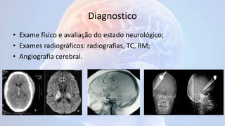 Diagnostico
• Exame físico e avaliação do estado neurológico;
• Exames radiográficos: radiografias, TC, RM;
• Angiografia cerebral.
 