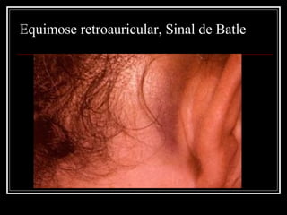 Equimose retroauricular, Sinal de Batle
 