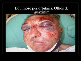 Equimose periorbitária, Olhos de
guaxinim
 
