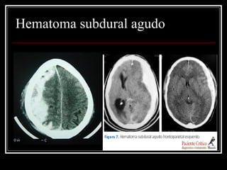 Hematoma subdural agudo
 