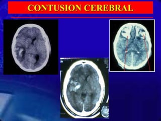 CONTUSION CEREBRAL
 