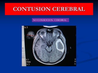 CONTUSION CEREBRAL
NO CONMOCION CEREBRAL
 