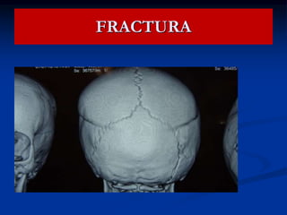FRACTURA
 