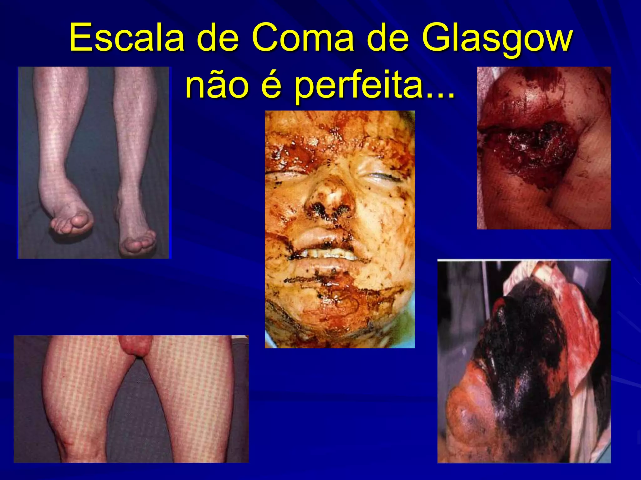 Escala de Coma de Glasgow
      não é perfeita...
 