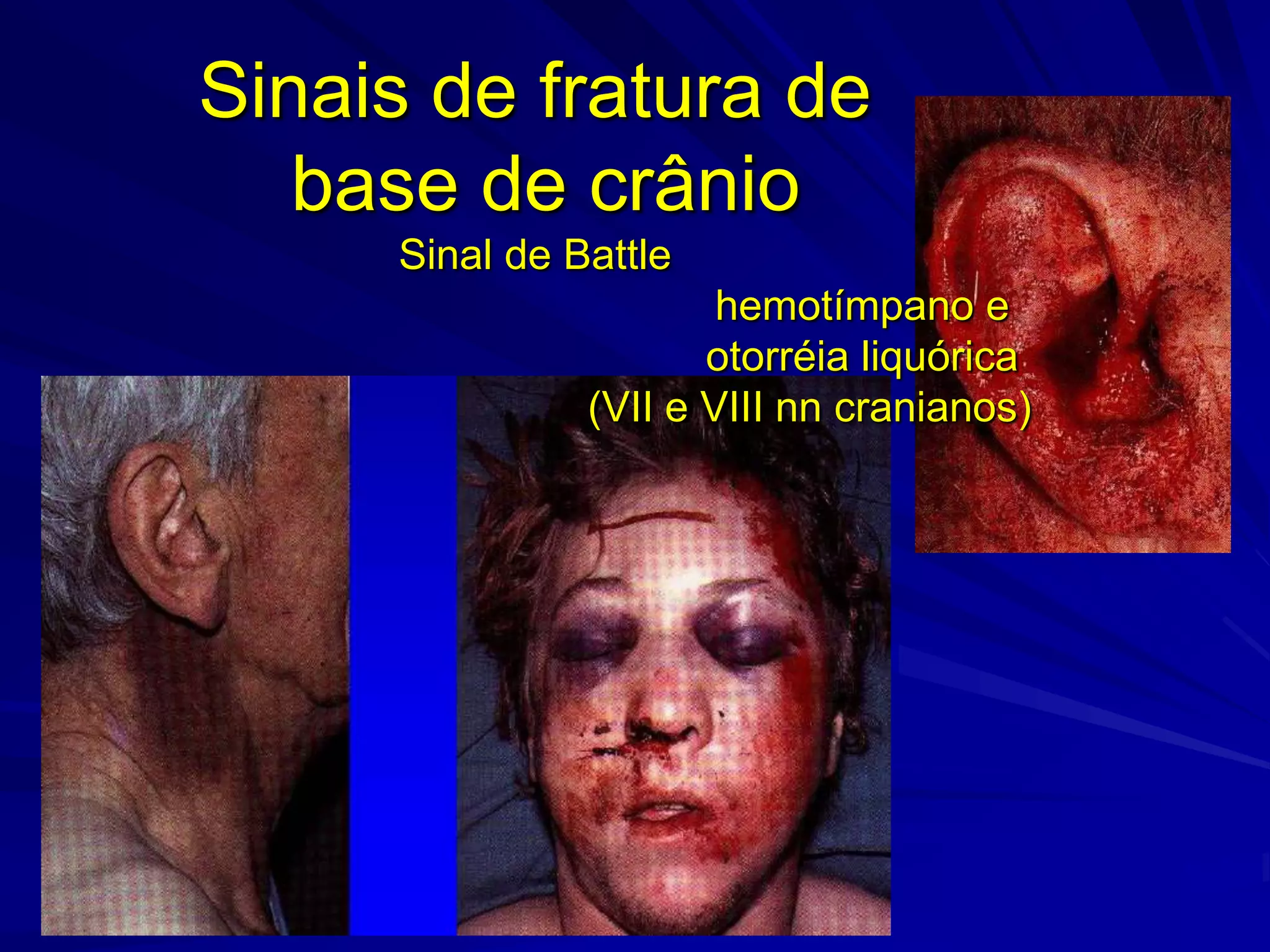 Sinais de fratura de
   base de crânio
     Sinal de Battle
                       hemotímpano e
                      otorréia liquórica
               (VII e VIII nn cranianos)
 