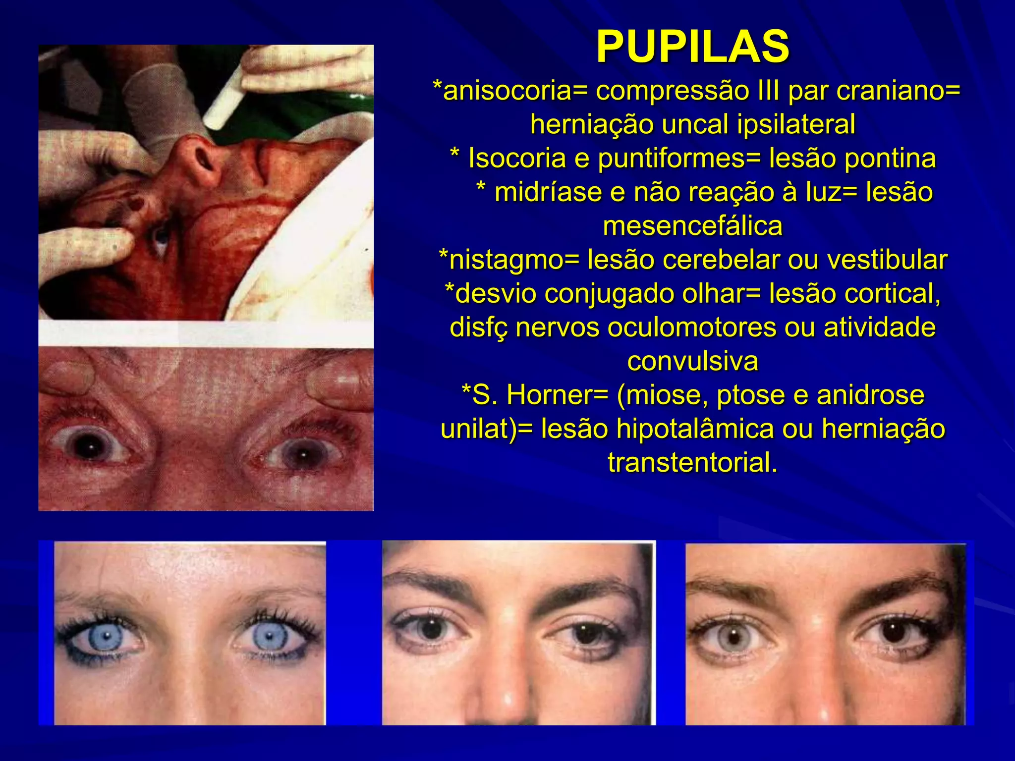 PUPILAS
*anisocoria= compressão III par craniano=
         herniação uncal ipsilateral
  * Isocoria e puntiformes= lesão pontina
     * midríase e não reação à luz= lesão
               mesencefálica
 *nistagmo= lesão cerebelar ou vestibular
  *desvio conjugado olhar= lesão cortical,
  disfç nervos oculomotores ou atividade
                  convulsiva
   *S. Horner= (miose, ptose e anidrose
 unilat)= lesão hipotalâmica ou herniação
                transtentorial.
 
