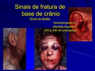 Sinais de fratura de
   base de crânio
     Sinal de Battle
                       hemotímpano e
                      otorréia liquórica
               (VII e VIII nn cranianos)
 