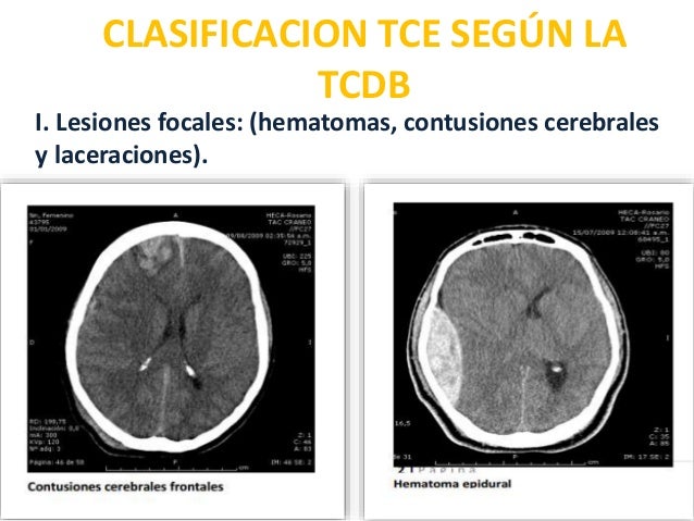 trauma craneoencefalico