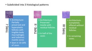 • Subdivided into 3 histological patterns
TYPE-I
• Architecture-
Partially
preserved and
hyperplastic
follicles with
tingible body
macrophages
and indistinct
mantle zones
• Seen in 10-20%
of cases
TYPE-
II
• Architecture-
Preserved
mostly with
residual follicles.
• In half of the
cases
TYPE-III
• Architecture-
Completely
effaced without
residual
follicles.
• In remaining
cases.
 