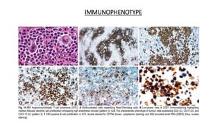 IMMUNOPHENOTYPE
• T cell antigens: εCD3, CD4, CD5 and CD7.
• Follicular dendritic cells: CD21, CD23, CD35
• TFH markers: CXCL13, CD10, PD1 & BCL6
• EBER (Epstein-Barr virus encoded small RNAs)
• Loss of sCD3 is more common in bone marrow and peripheral blood
compared to lymph nodes.
• CD8 –Ve and loss of CD7 is also observed
 