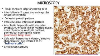 MICROSCOPY
• Small-medium-large anaplastic cells
• Interfollicular T zones and subcapsular
sinuses infiltration
• Cohesive growth pattern
• Intrasinusoidal infiltration pattern
• Anaplastic large cells with abundant
cytoplasm, wreath-like or multiple nuclei,
open chromatin, multiple nucleoli,
perinuclear eosinophilic region
(prominent Golgi zone)
• Cells with horseshoe / kidney / embryo
shaped nuclei are referred to as
“hallmark cells”.
• Brisk mitotic activity
 