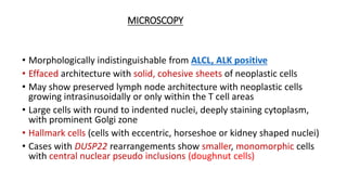 MICROSCOPY
• Morphologically indistinguishable from ALCL, ALK positive
• Effaced architecture with solid, cohesive sheets of neoplastic cells
• May show preserved lymph node architecture with neoplastic cells
growing intrasinusoidally or only within the T cell areas
• Large cells with round to indented nuclei, deeply staining cytoplasm,
with prominent Golgi zone
• Hallmark cells (cells with eccentric, horseshoe or kidney shaped nuclei)
• Cases with DUSP22 rearrangements show smaller, monomorphic cells
with central nuclear pseudo inclusions (doughnut cells)
 