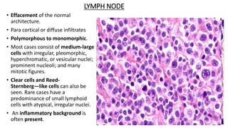 LYMPH NODE
• Effacement of the normal
architecture.
• Para cortical or diffuse infiltrates
• Polymorphous to monomorphic.
• Most cases consist of medium-large
cells with irregular, pleomorphic,
hyperchromatic, or vesicular nuclei;
prominent nucleoli; and many
mitotic figures.
• Clear cells and Reed-
Sternberg―like cells can also be
seen. Rare cases have a
predominance of small lymphoid
cells with atypical, irregular nuclei.
• An inflammatory background is
often present.
 