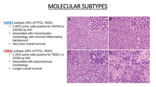 MOLECULAR SUBTYPES
•GATA3 subtype (35% of PTCL, NOS):
• ≥ 50% tumor cells positive for GATA3 or
CXCR3 by IHC
• Associated with monomorphic
morphology with minimal inflammatory
background
• Very poor overall survival
•TBX21 subtype (58% of PTCL, NOS):
• ≥ 20% tumor cells positive for TBX21 or
CCR4 by IHC
• Associated with polymorphous
morphology
• Longer overall survival
 
