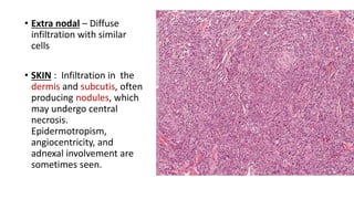 • Extra nodal – Diffuse
infiltration with similar
cells
• SKIN : Infiltration in the
dermis and subcutis, often
producing nodules, which
may undergo central
necrosis.
Epidermotropism,
angiocentricity, and
adnexal involvement are
sometimes seen.
 