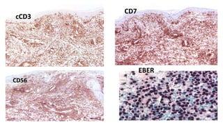 CD56
CD7
cCD3
EBER
 