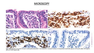 MICROSCOPY
• Intestinal involvement:
Ulcerated lesion with diffuse
and pleomorphic infiltrate of
medium to large cells ,
angulated nuclei, prominent
nucleoli and abundant
cytoplasm.
Mitotic figures and necrosis
are common.
Angiotropism.
Background inflammatory
cells.
Features of celiac disease –
Mucosa adjacent to EATL.
• Lymph node : Sinusoidal
pattern.
 