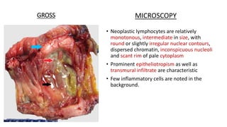 GROSS
• Neoplastic lymphocytes are relatively
monotonous, intermediate in size, with
round or slightly irregular nuclear contours,
dispersed chromatin, inconspicuous nucleoli
and scant rim of pale cytoplasm
• Prominent epitheliotropism as well as
transmural infiltrate are characteristic
• Few inflammatory cells are noted in the
background.
MICROSCOPY
 