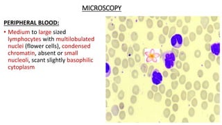 MICROSCOPY
PERIPHERAL BLOOD:
• Medium to large sized
lymphocytes with multilobulated
nuclei (flower cells), condensed
chromatin, absent or small
nucleoli, scant slightly basophilic
cytoplasm
 