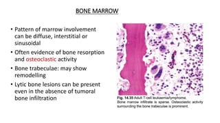 BONE MARROW
• Pattern of marrow involvement
can be diffuse, interstitial or
sinusoidal
• Often evidence of bone resorption
and osteoclastic activity
• Bone trabeculae: may show
remodelling
• Lytic bone lesions can be present
even in the absence of tumoral
bone infiltration
 