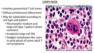 LYMPH NODE
• Involves paracortical T cell zones
• Diffuse architectural effacement
• May be subdivided according to
cell type and pattern
• Pleomorphic medium and
large cell type / pattern (most
common)
• Anaplastic large cell-like
• Hodgkin lymphoma-like: seen
in early phase of some adult T
cell lymphoma
 