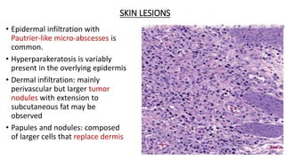 SKIN LESIONS
• Epidermal infiltration with
Pautrier-like micro-abscesses is
common.
• Hyperparakeratosis is variably
present in the overlying epidermis
• Dermal infiltration: mainly
perivascular but larger tumor
nodules with extension to
subcutaneous fat may be
observed
• Papules and nodules: composed
of larger cells that replace dermis
 